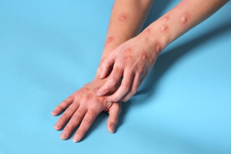 1736287768_Casos-de-mpox-en-Espana-en-2024-ninguno-de-la.jpg