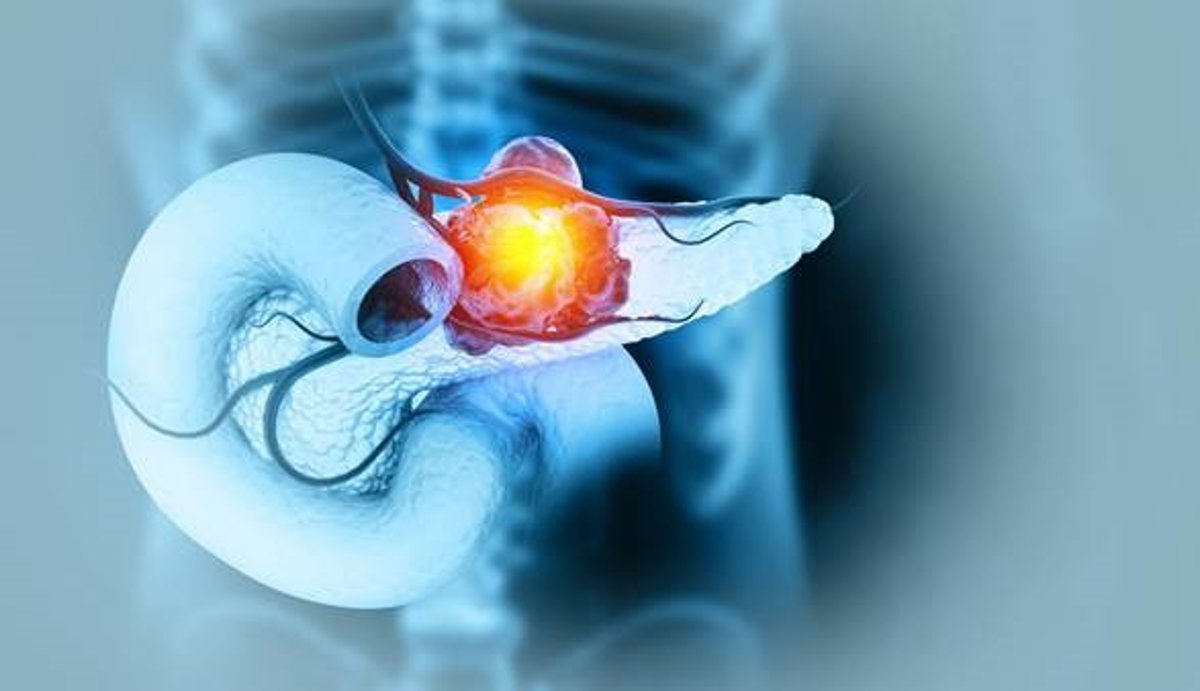 1753166005_Estrategia-contra-cancer-de-pancreas-radioterapia-con-hipertermia-y-nanoparticulas.jpg