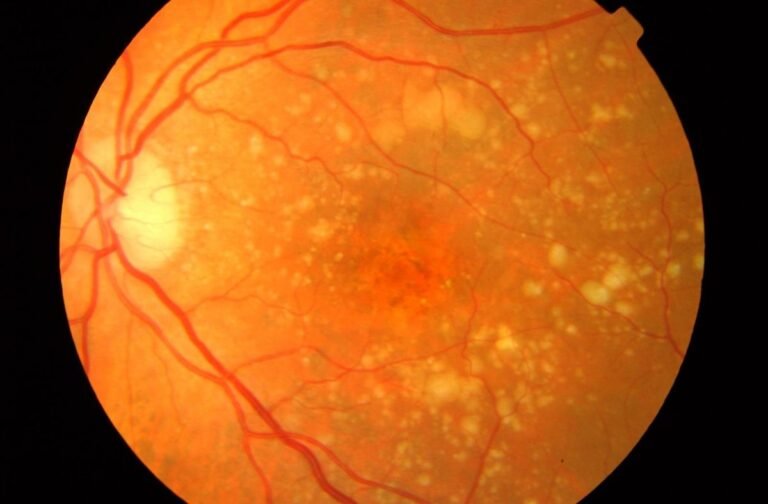 Implante-de-retina-devuelve-vision-central-a-pacientes-con-DMAE.jpg
